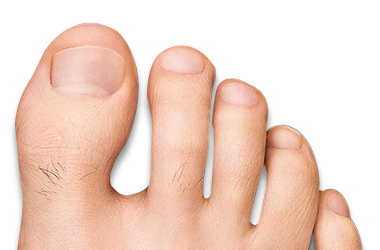 Foot with toe fungus