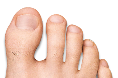 Foot with mild toenail fungus