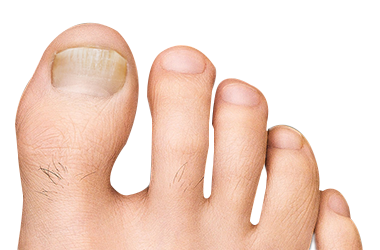 Fungal Infection of the Nail. Close-up of a Toenail Affected by