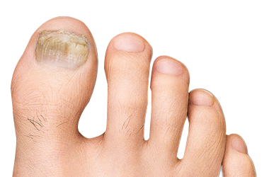 Foot with moderate toenail fungus