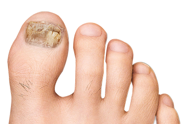 Foot with toe fungus
