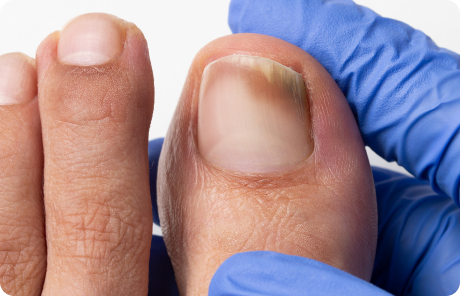 A toe with toenail fungus